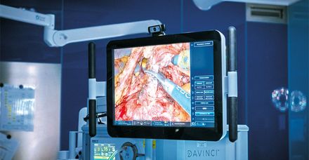 Auf dem Monitor sichtbar: Die computergesteuerten Instrumente führen den Schnitt millimetergenau – gesteuert über die Konsole des Chirurgen Auf dem Monitor sichtbar: Die computergesteuerten Instrumente führen den Schnitt millimetergenau – gesteuert über die Konsole des Chirurgen