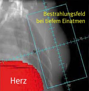 Brustkrebs: Bestrahlungsfeld ist abhängig von der Atmung