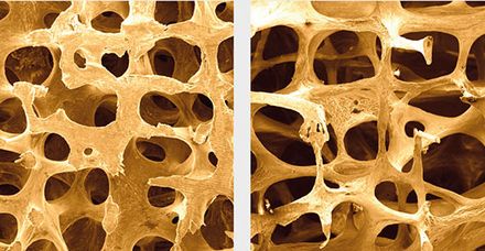 Osteoporose im Bild: links gesunde Knochenstruktur; rechts osteoporotischer, brüchiger Knochen (Foto: Wikimedia Commons, Katajunk)