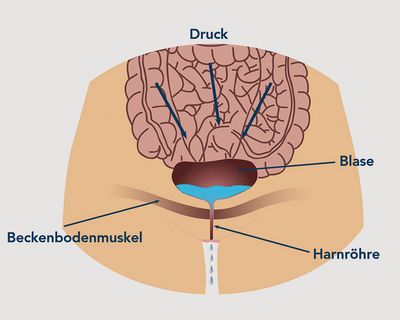 Ist die Beckenbodenmuskulatur geschwächt, kann es zu unwillkürlichem Urinverlust kommen. Etwa beim Husten, Niesen oder Lachen sowie beim Heben oder Sport (Quelle: www.ami.at)