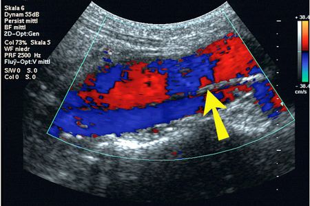 Farbduplexsonografische Aufnahme einer Aortendissektion im Längsschnitt